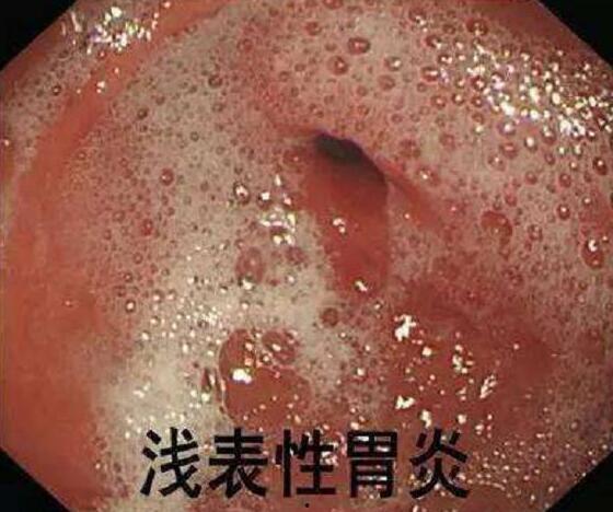 胃炎病吃土瓜好吗,缓解不适的天然良方