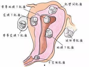 子宫肌瘤吃瓠子瓜吗,子宫肌瘤患者适宜食用瓠子瓜的饮食建议
